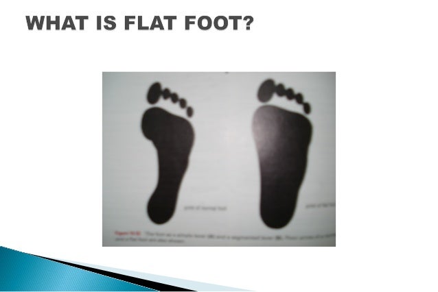 Adult Acquired Flat Feet