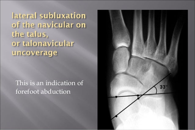 Adult Acquired Flat Feet