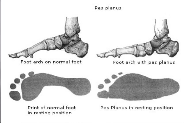 Adult Acquired Flat Foot