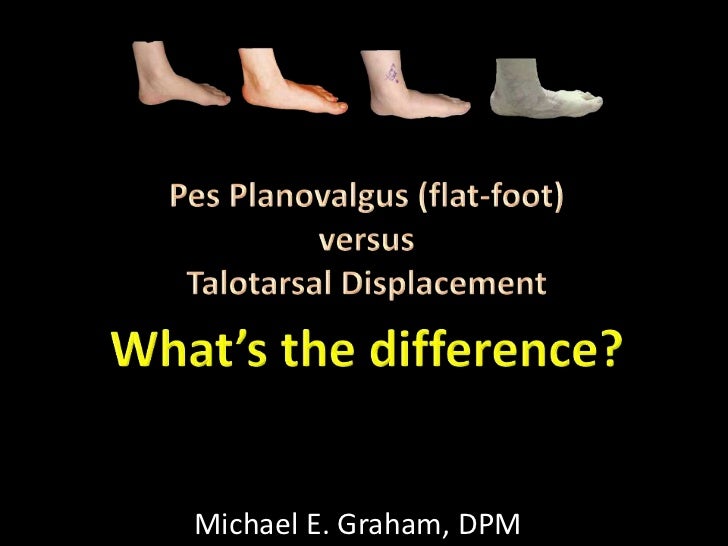 Acquired Flat Feet