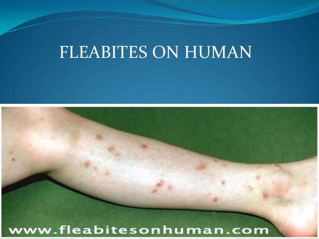 flea bite on human #11