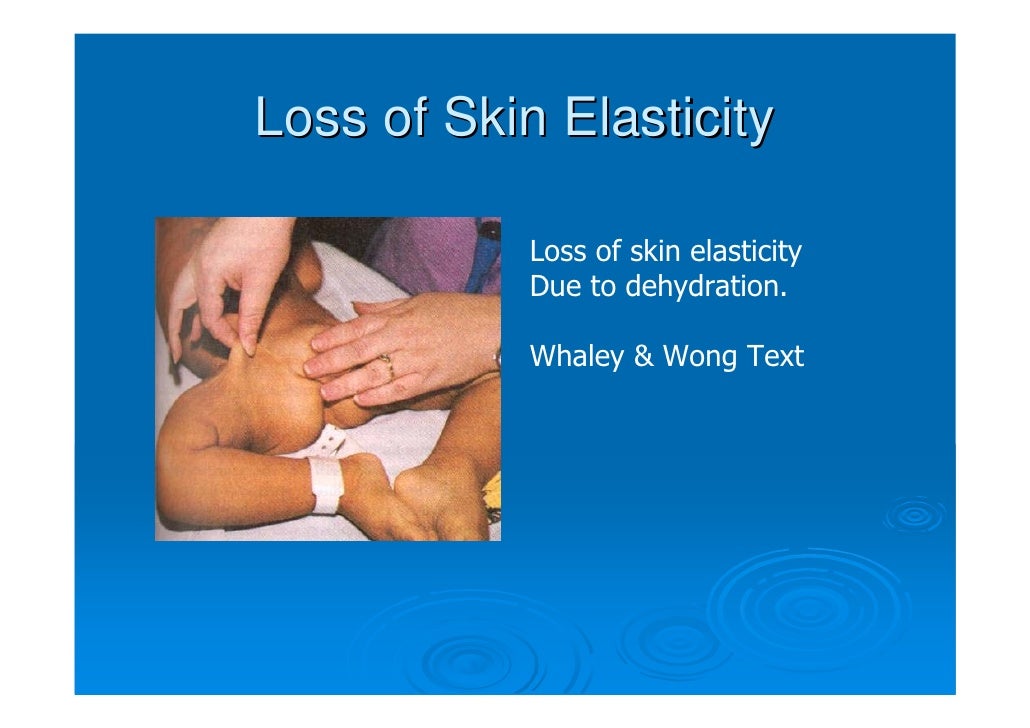 Kidney Failure Dehydration