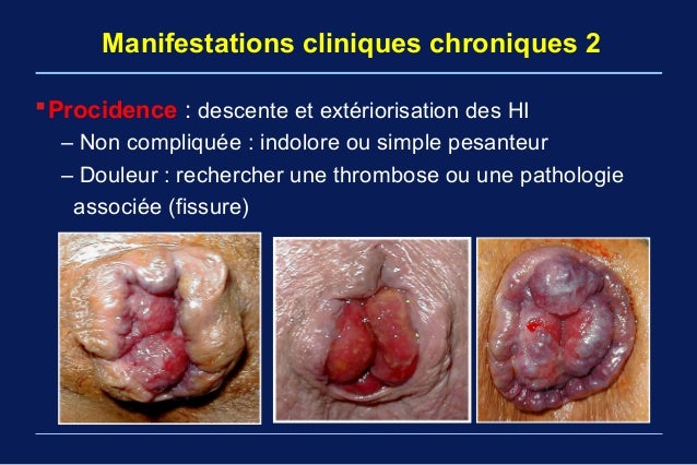 Tumeur Prostate