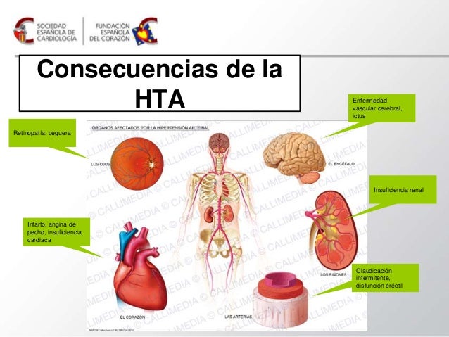 ¿Por qué la hipertensión arterial puede dañar el corazón? ¿Por qué la hipertensión arterial puede dañar el corazón?