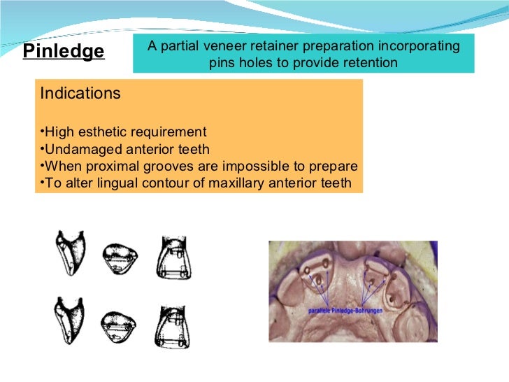 Introduction to fixed partial denture