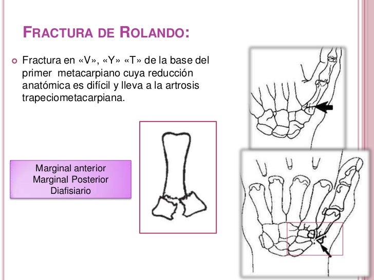 Fractura de 1° y 5° metacarpiano