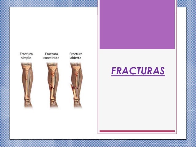 FRACTURA CAUSAS fractura causas: