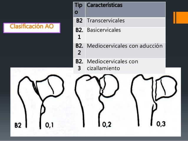 Fracturas De Femur Proximal