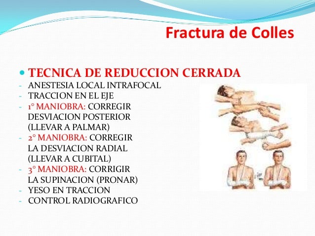 Fracturas del radio distal