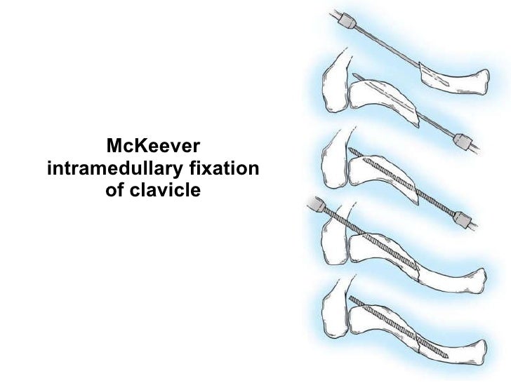 Fractures of the clavicle