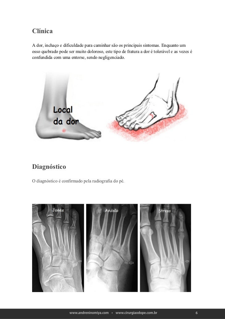 Fratura do quinto metatarso