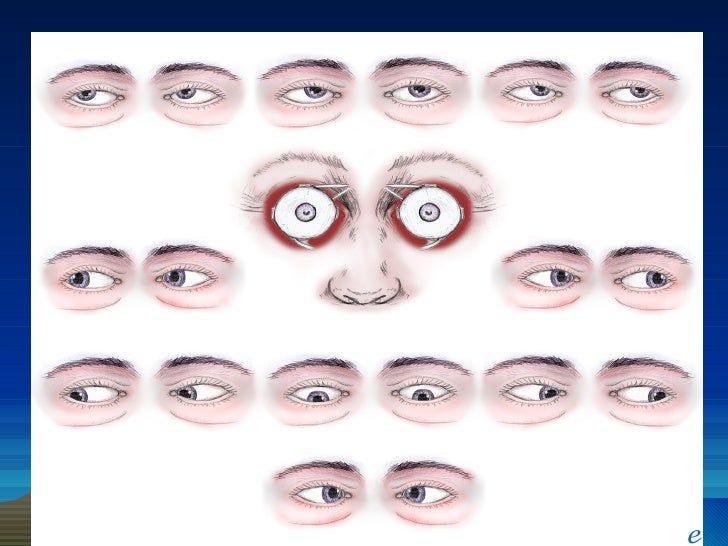 stroke cure research hemorrhagic stroke diagnostic assessments