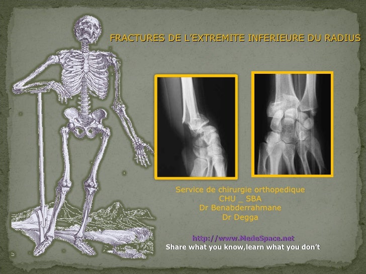 FRACTURES DE L’EXTREMITE INFERIEURE DU RADIUS