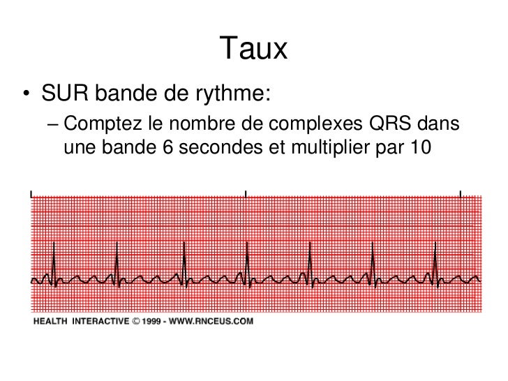 Base ECG et l'interprétation du rythme (French) Symposia