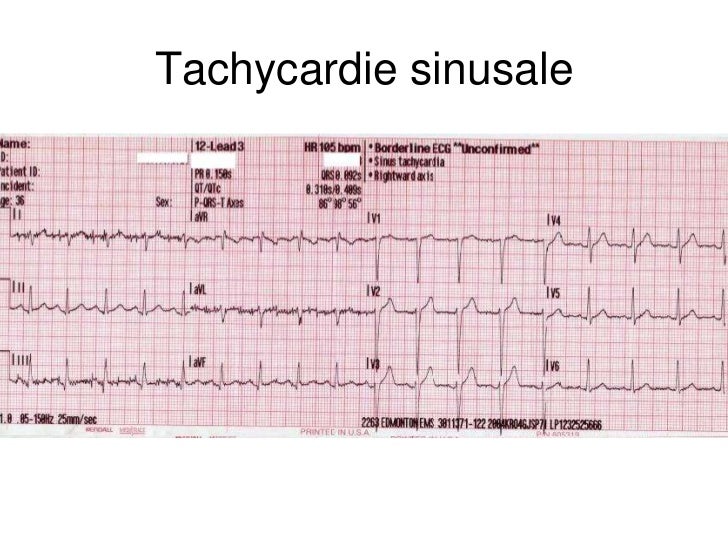 Base ECG et l'interprétation du rythme (French) Symposia