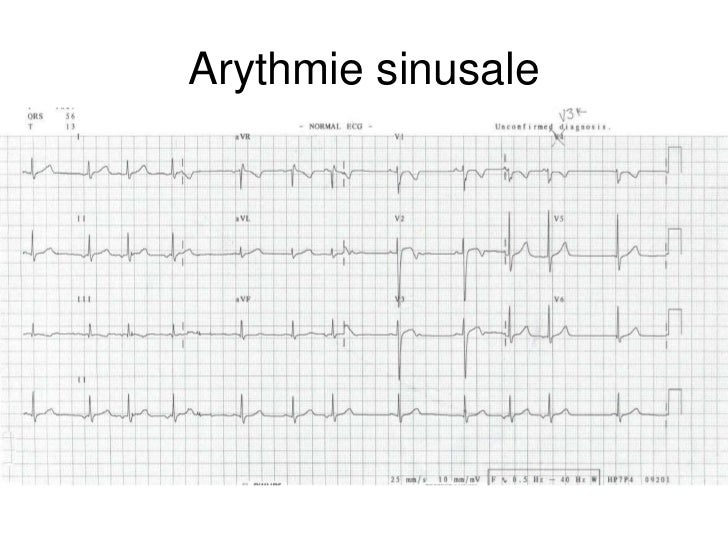 Base ECG et l'interprétation du rythme (French) Symposia