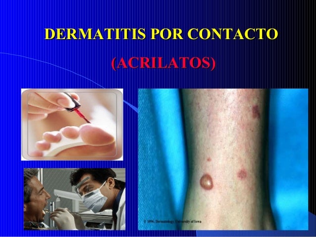 De que comenzar la cebadura del niño con atopicheskim por la dermatitis