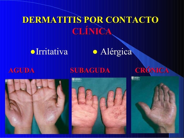 Para recibir la invalidez por la psoriasis que es necesario