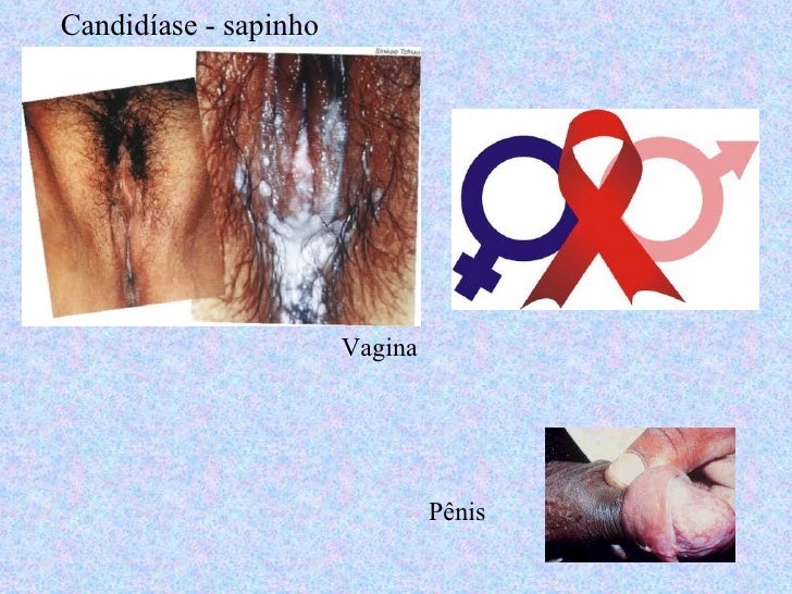 Tratamento de uma inflamação de um prego de um dedo do pé