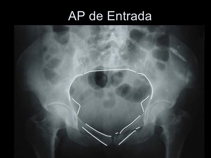 Fx De Pelvis