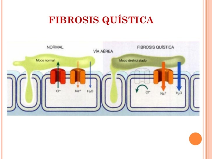 Fibrosis quística