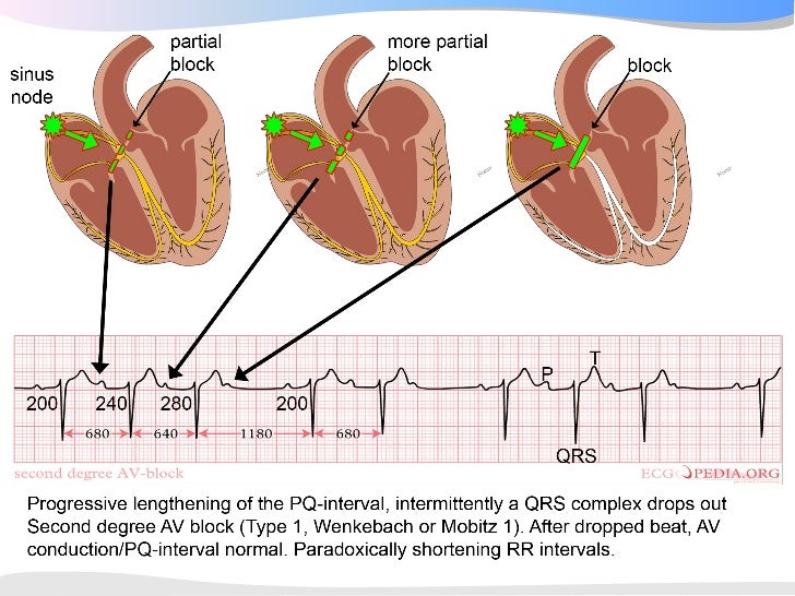 Geleidingstoornissen ECGpedia 2008