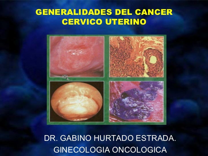 Cancer Cervicouterino Articulos