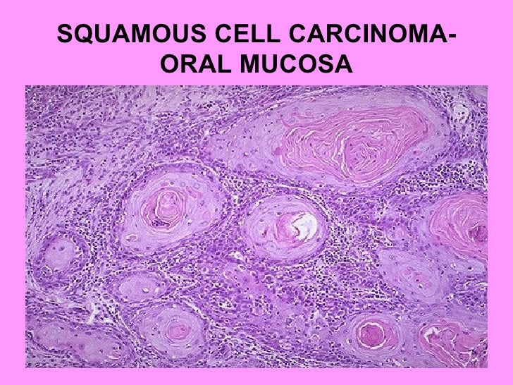 Oral Squamous Cell 111
