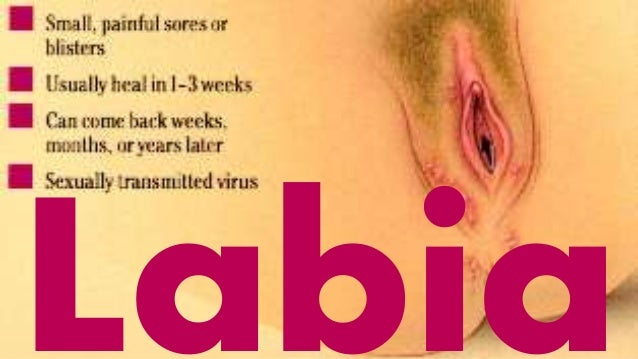 labia cyst? - Women's Health - MedHelp