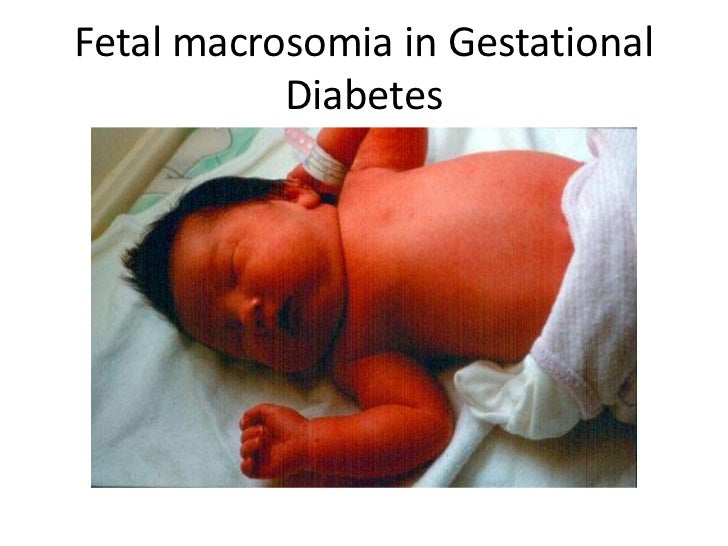 Macrosomia Fetale E Sindrome Di Down