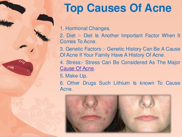 Causes of pimples on face in adults