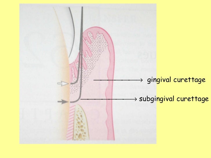 Gingival curettage