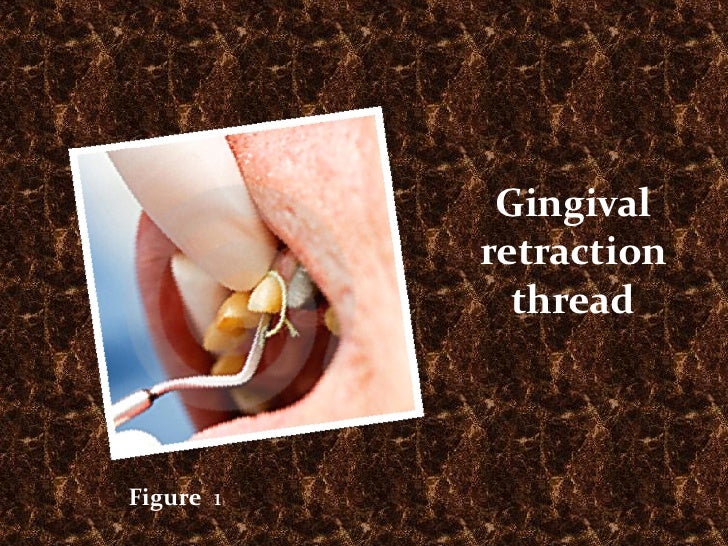 Gingival retraction