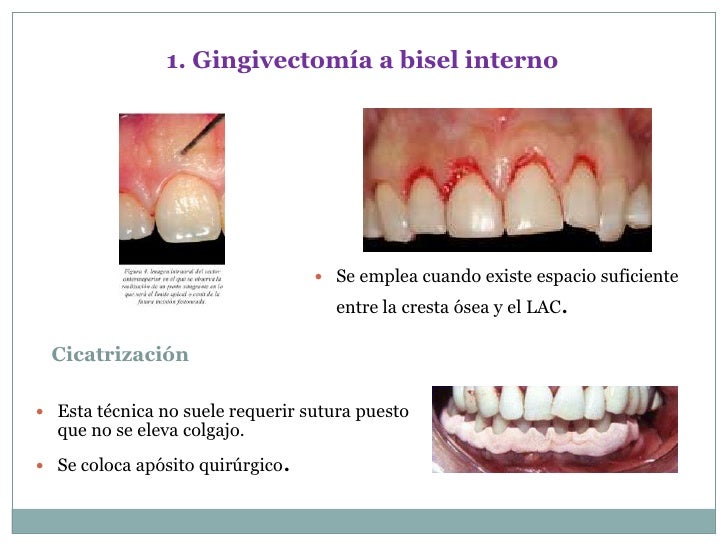 Gingivectomia bisel interno