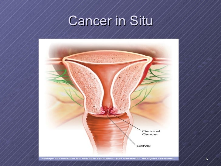 Signs Ng Cervical most cancers