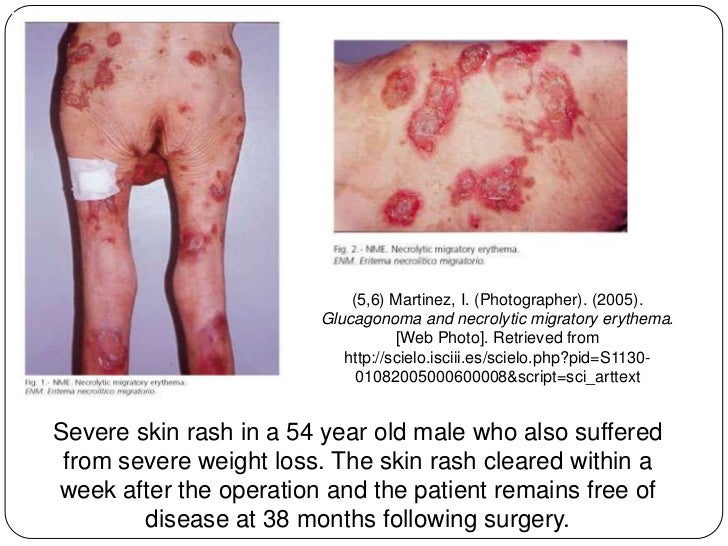 can methotrexate cause skin rash
