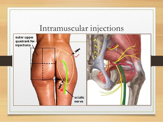 Gluteal region clinical anatomy