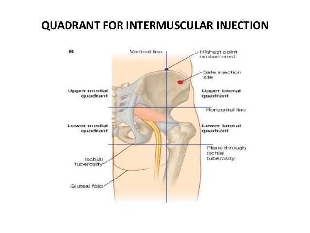 Gluteus Maximus Intramuskuläre Injektion Gesäß Quadrant www.slideshare.net