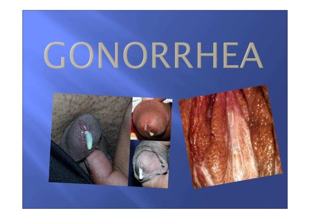 chlamydia and gonorrhea symptoms chlamydia and gonorrhea symptoms