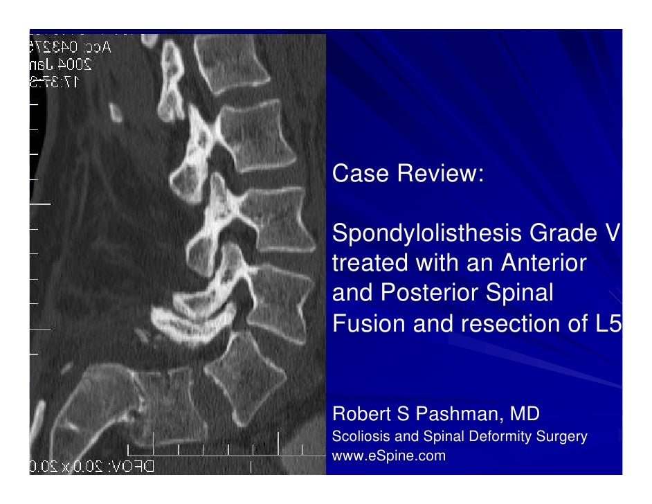 Spondylolisthesis grades image