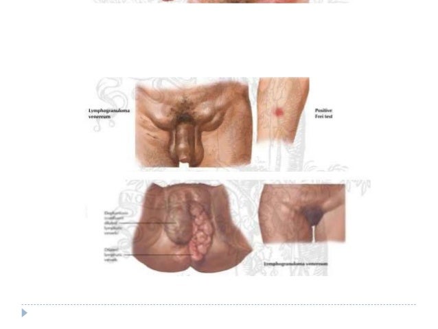 LCI-richtlijn Chlamydia trachomatis en lymfogranuloma ...