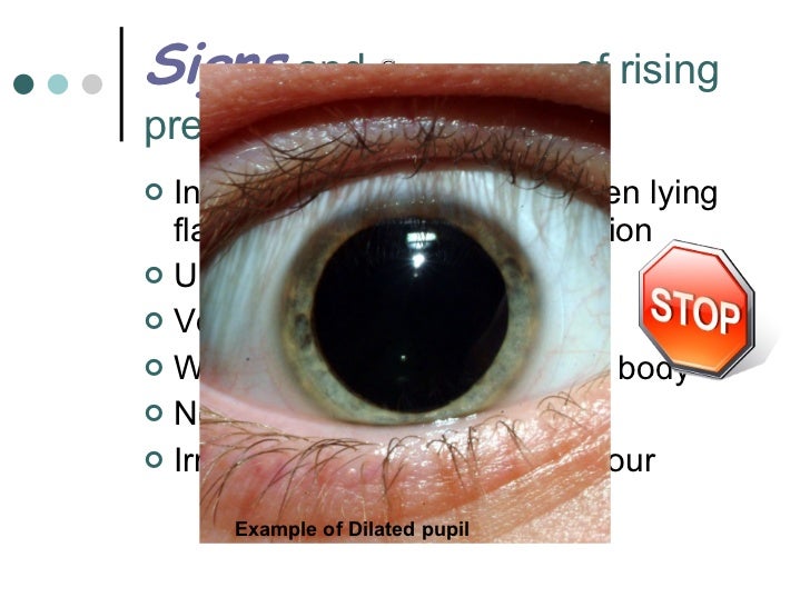 concussion symptoms eyes dilated anexa beauty concussion pupils light