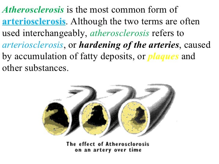 Heart attack plaque blood pressure