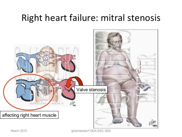 Causes Of Meatal Stenosis In Adults