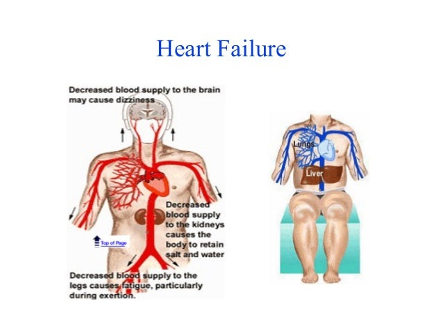 517 Heart Failure And Lasix 745