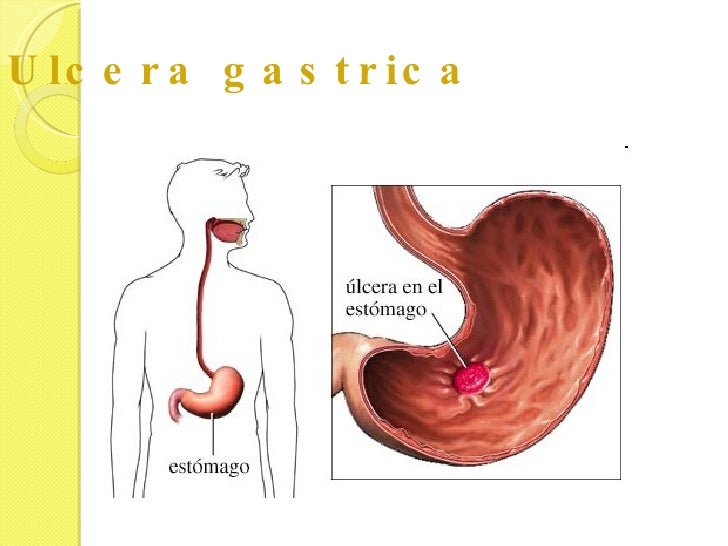 Ulcera gastrica 