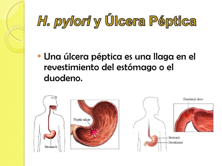 <ul><li>Una úlcera péptica es una llaga en el revestimiento del estómago o el duodeno. </li></ul>