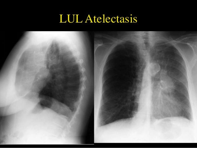Helpful radiological signs in cxr25 11-91