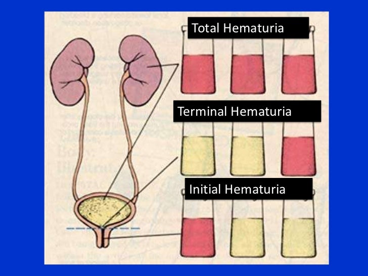 Hematuria and obstructive uropathy