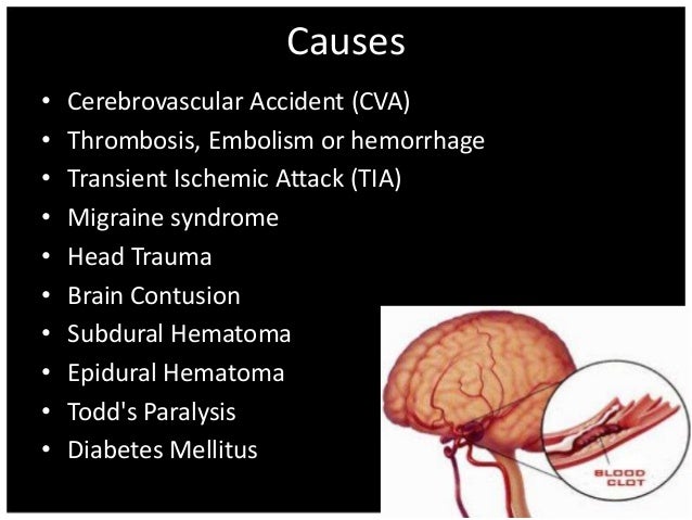 tia stroke brain